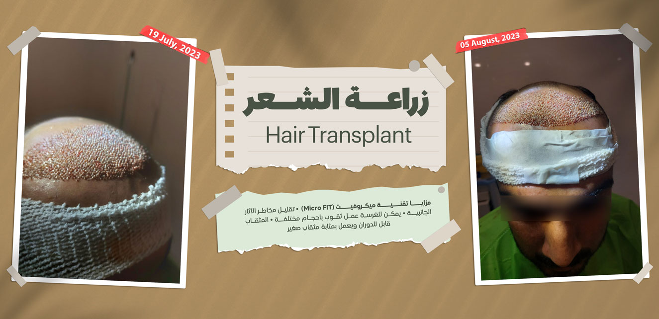 Hair Transplant