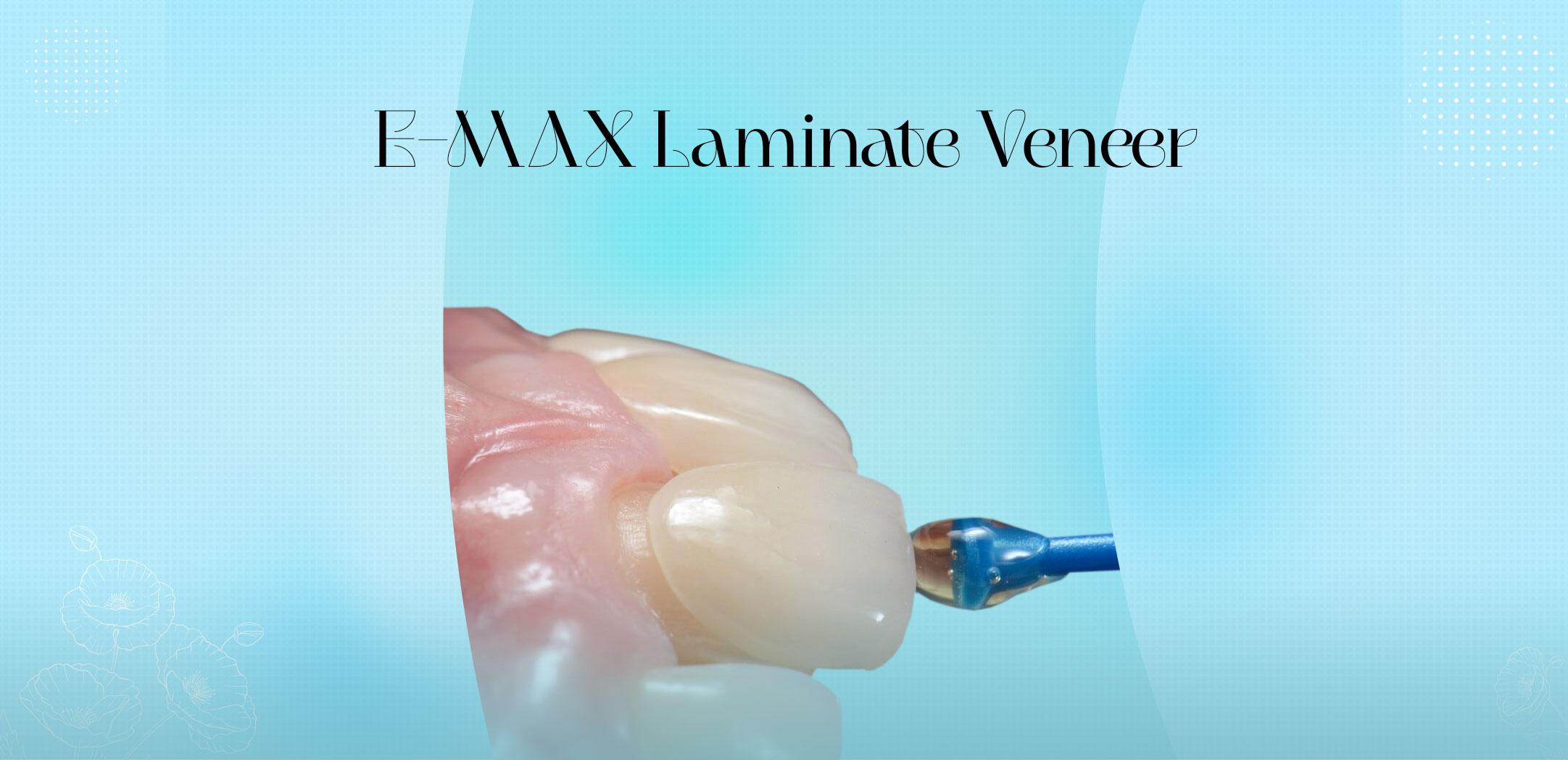 E-MAX Laminate Veneer