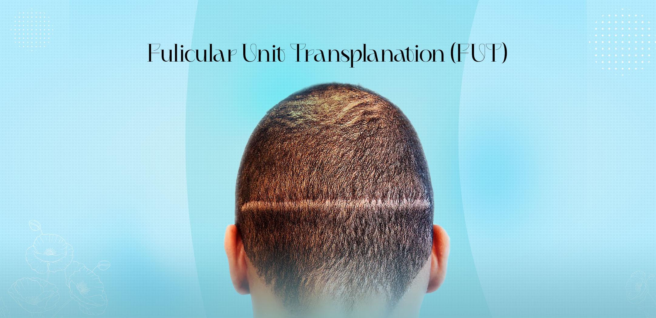 Fulicular Unit Transplanation (FUT)