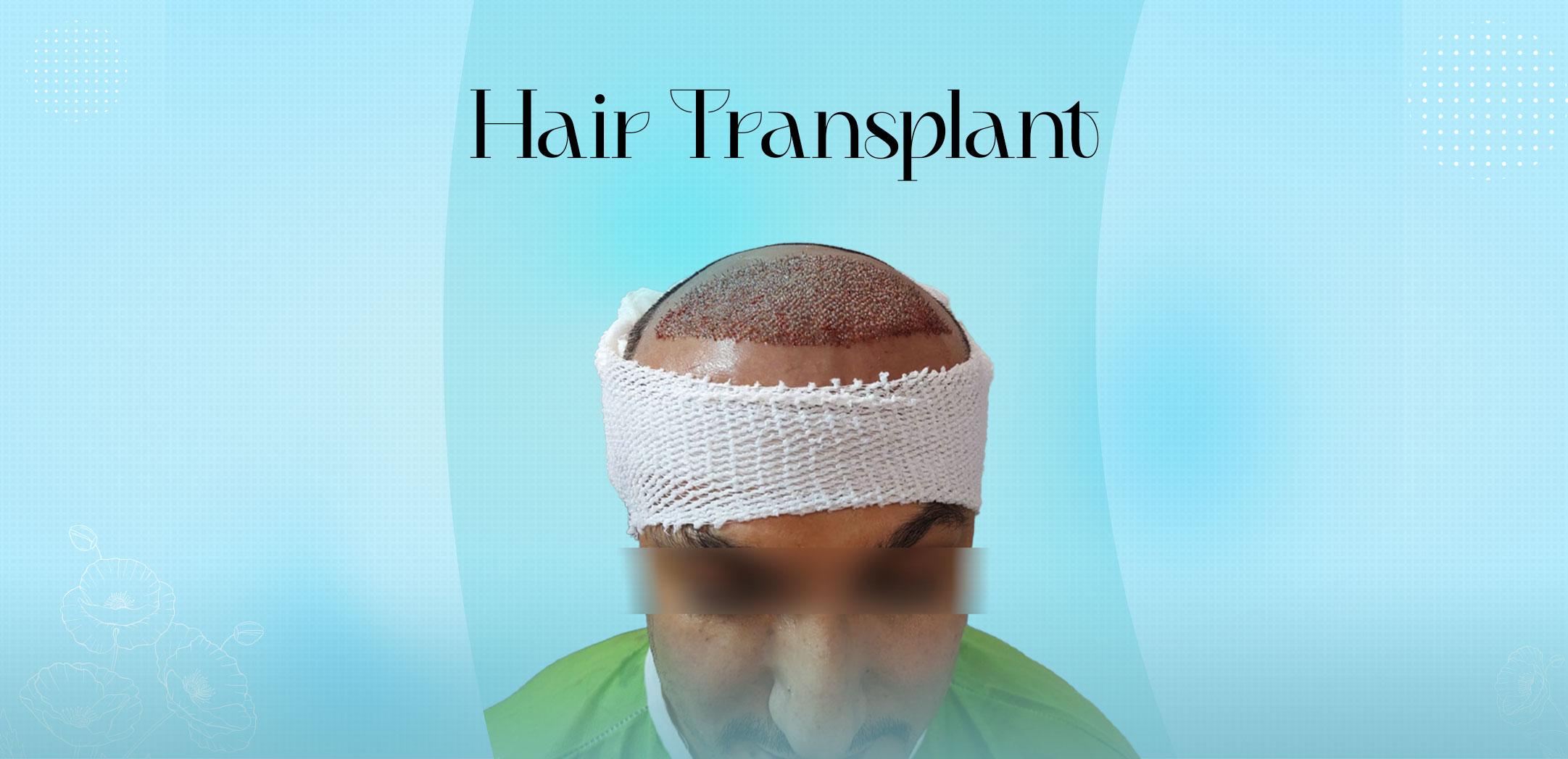 Hair Transplant