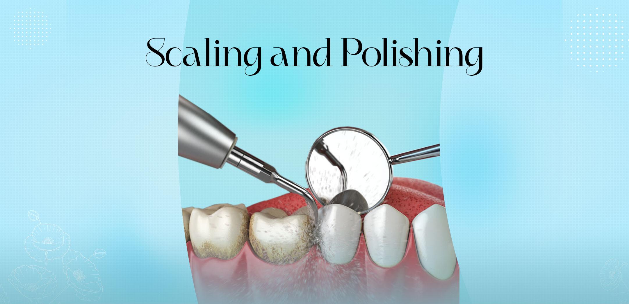 Scaling and Polishing