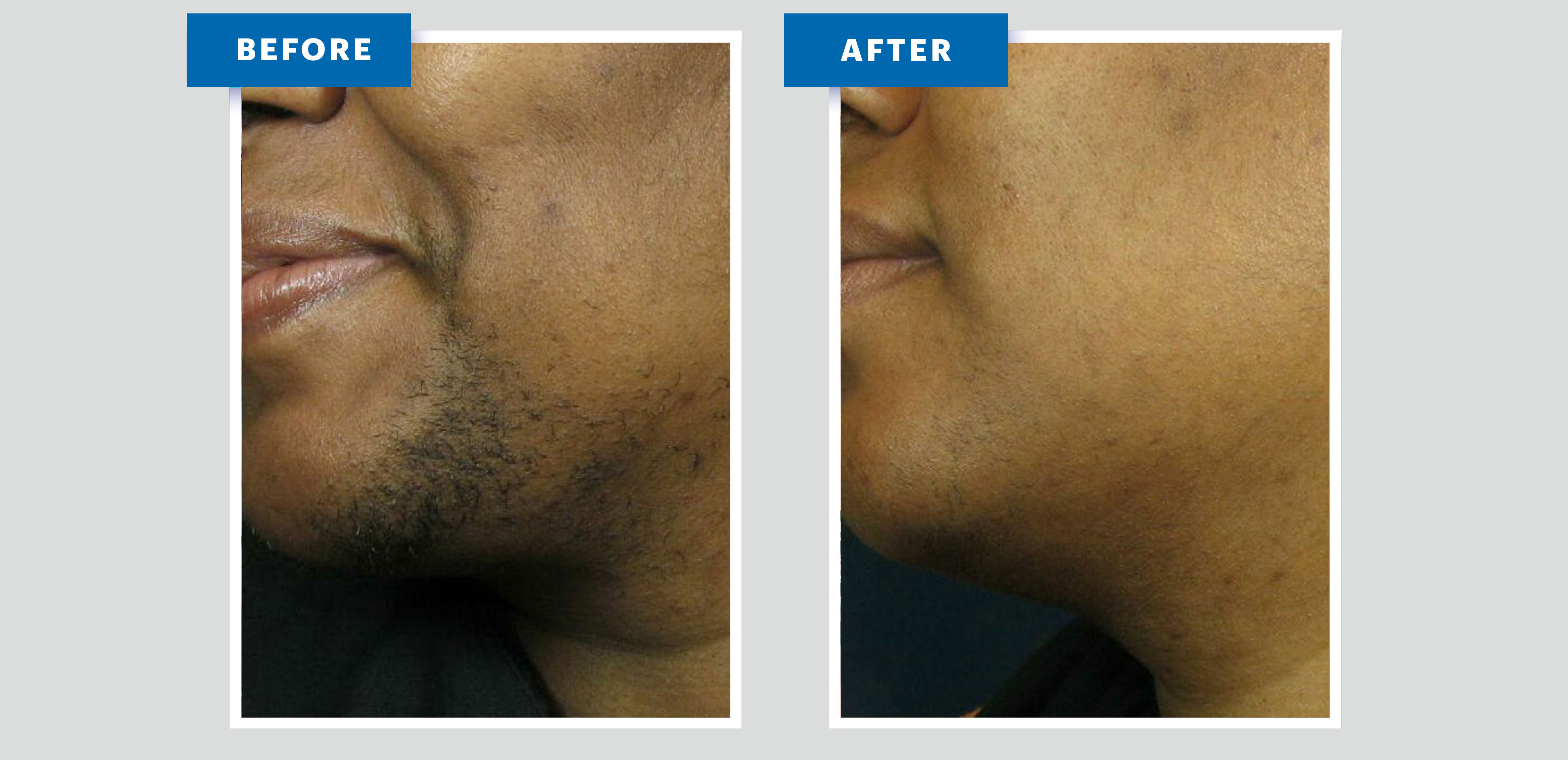 Hair Removal