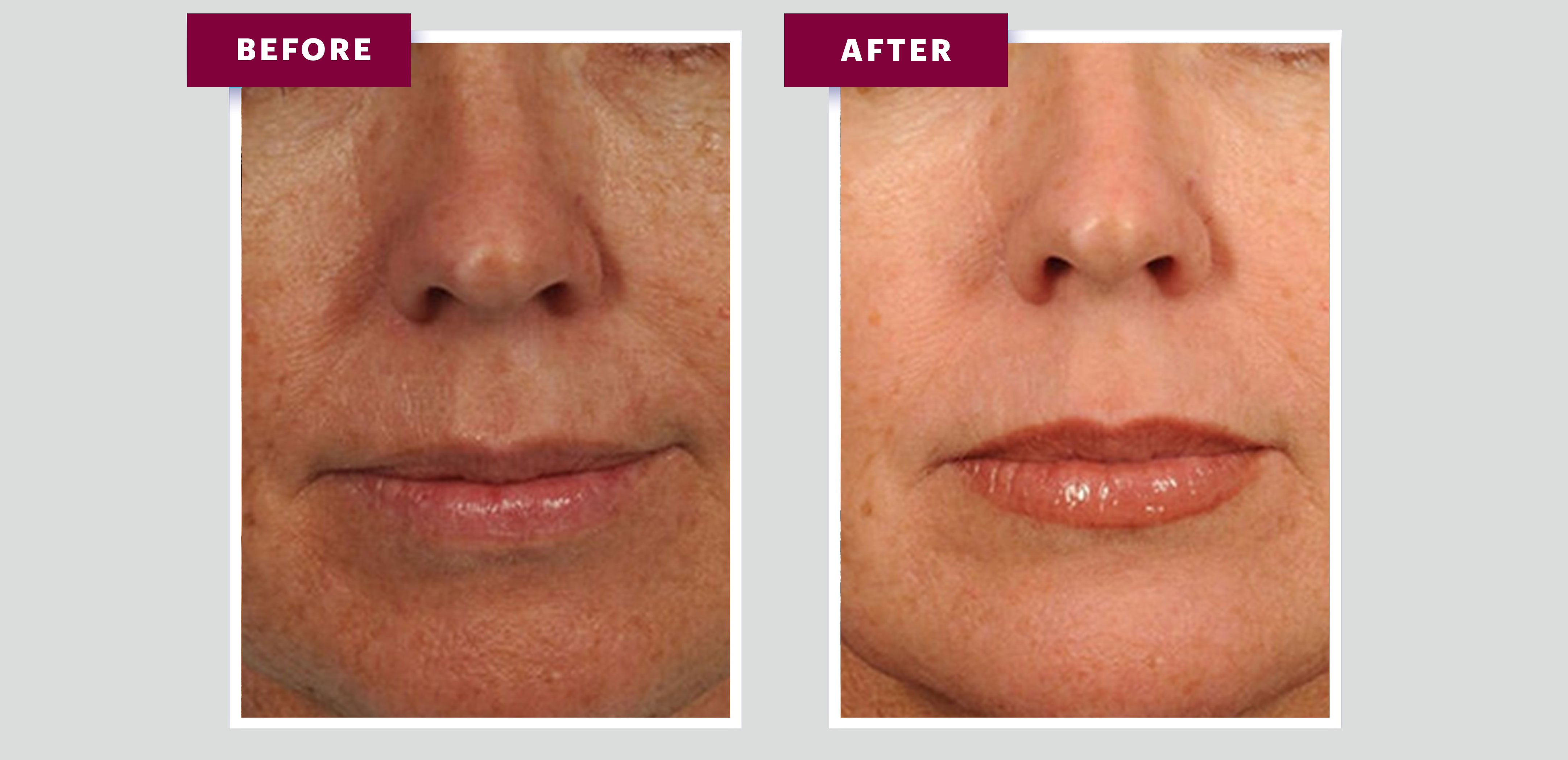 Microdermabrasion