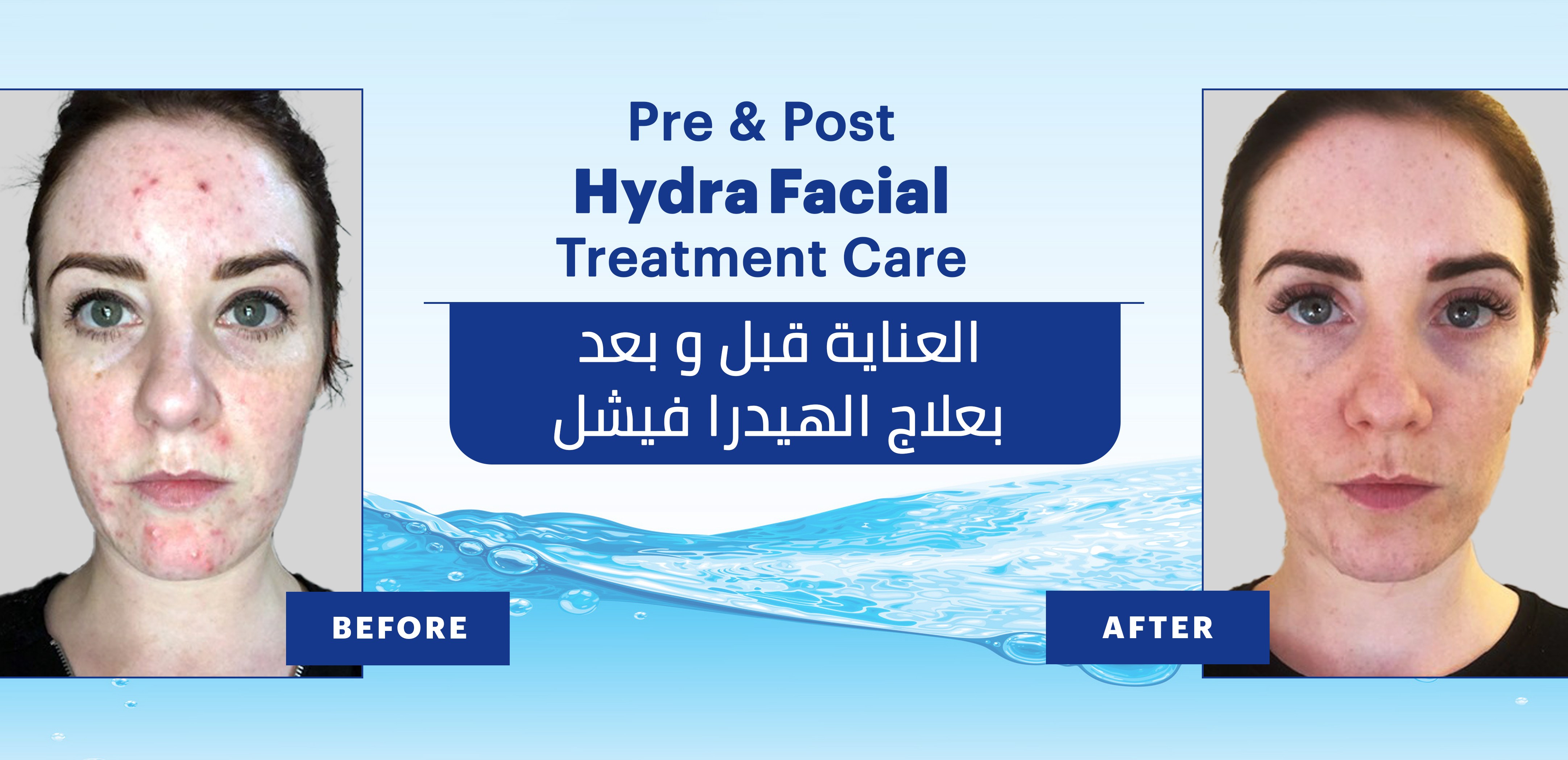 hydrafacial