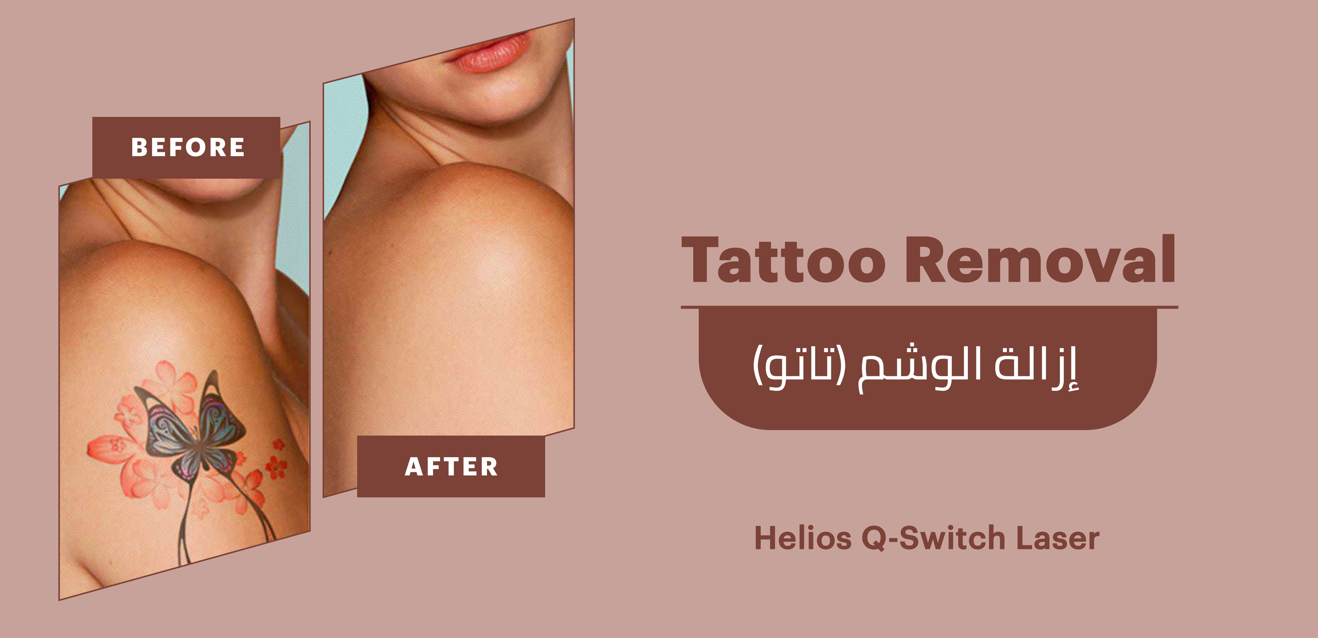 POST TREATMENT OF TATT00 REMOVAL