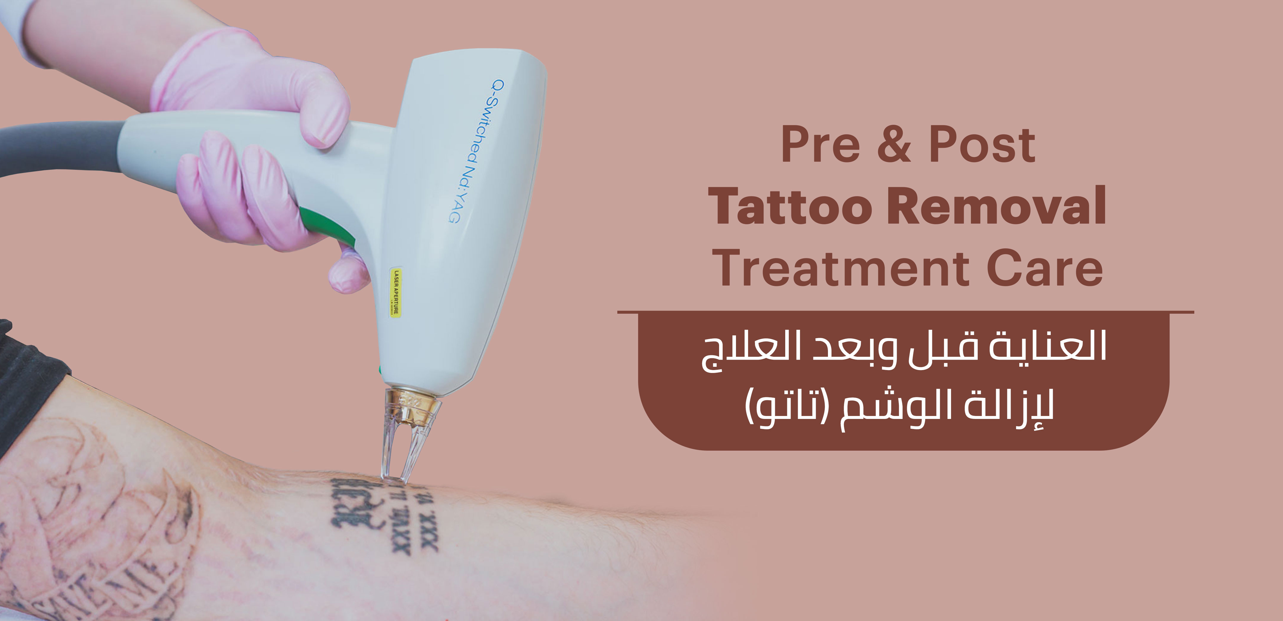 Tato removal Q-switch
